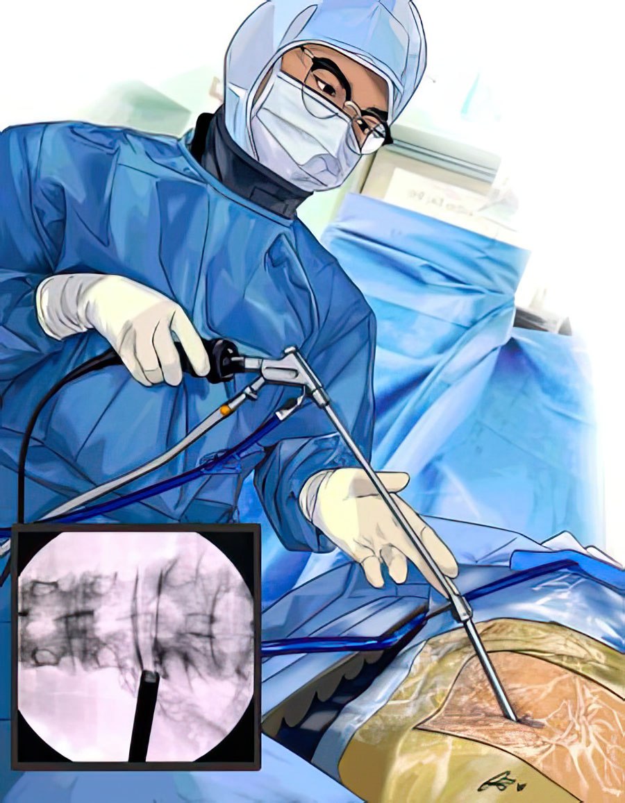Beyond the portal wars: forging a new consensus in endoscopic spine surgery