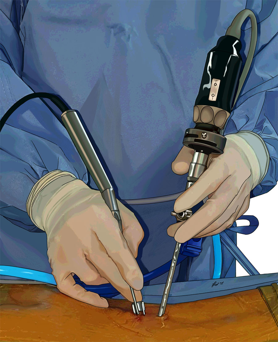 Beyond the portal wars: forging a new consensus in endoscopic spine surgery