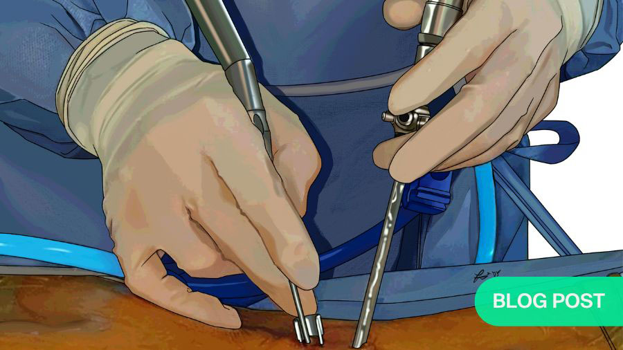 Beyond the portal wars: forging a new consensus in endoscopic spine surgery 