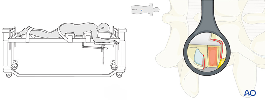 MIS TLIF: Tips and tricks to improve lordosis and achieve solid fusion
