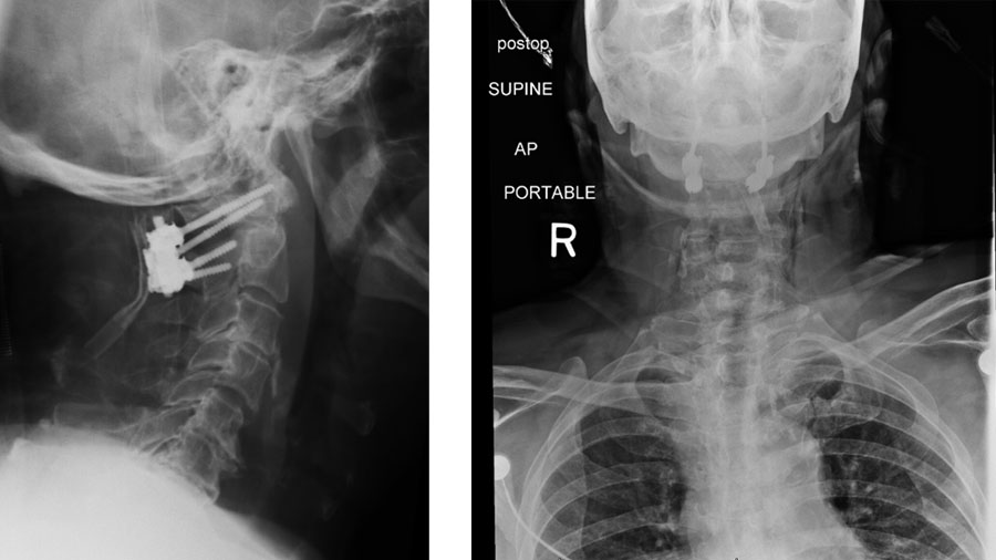 Atlantoaxial instability—decision options in the modern era