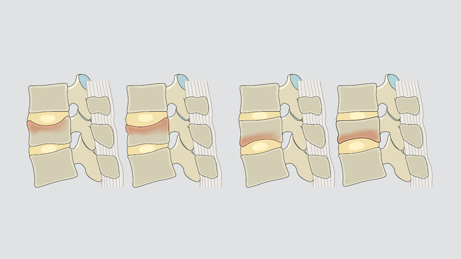 Taming the challenge of osteoporotic vertebral fractures: the AO Spine–DGOU OF classification and score in modern practice