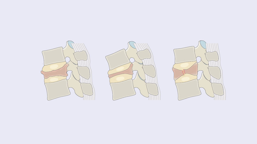 Taming the challenge of osteoporotic vertebral fractures: the AO Spine–DGOU OF classification and score in modern practice