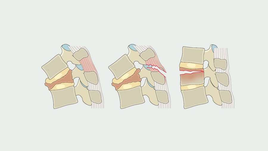 Taming the challenge of osteoporotic vertebral fractures: the AO Spine–DGOU OF classification and score in modern practice