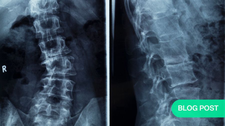 Adolescent idiopathic scoliosis: Curve progression in brace patients can be predicted by curve flexibility and in-brace correction
