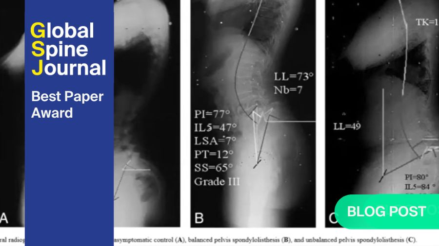 Degenerative Spondylolisthesis and Retrolisthesis - relationship with whole body radiographic parameters