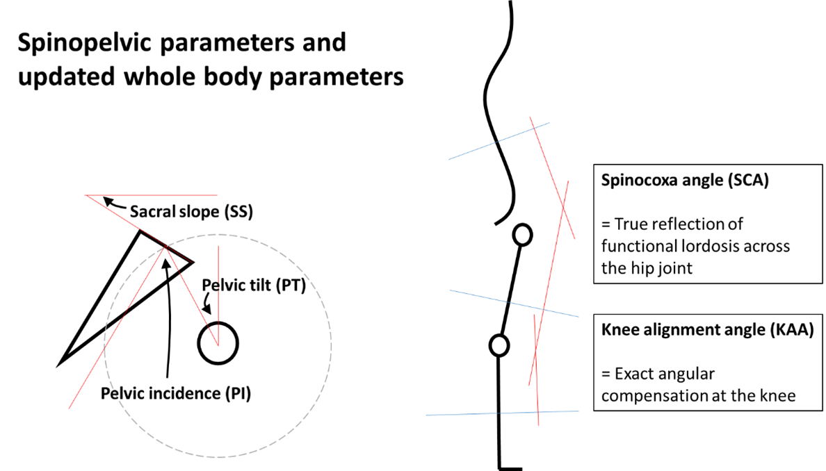 Figure 1-Diagrammatic representation of spinopelvic parameters (PI, SS and PT) and updated whole body parameters (SCA and KAA)