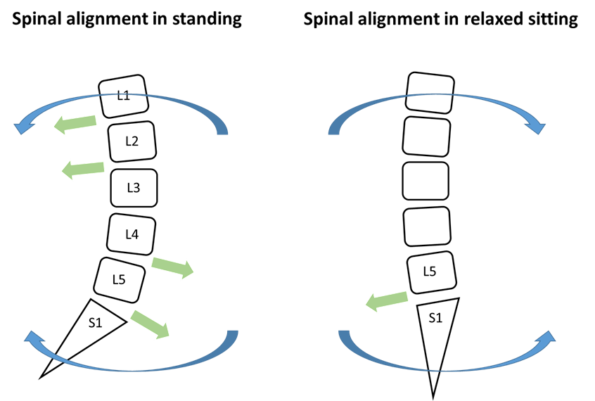 Figure 2: Spinal alignment in standing and sitting and force vector at each functional spinal unit leading to spondylolisthesis or retrolisthesis 