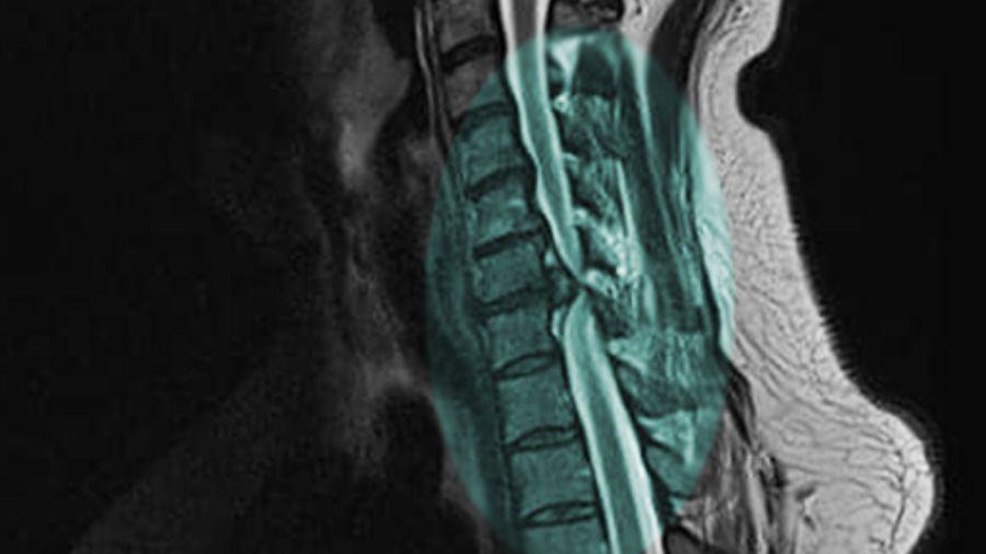 AO Spine continues to advance the field of Degenerative Cervical Myelopathy research through an incubator program