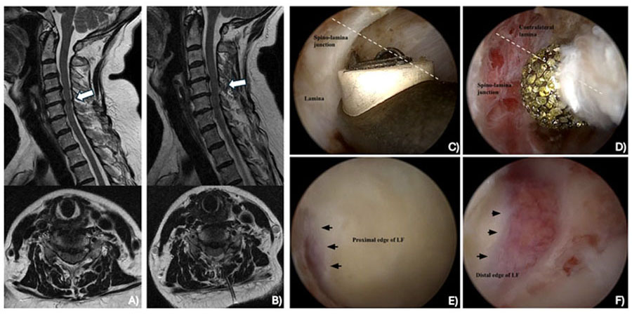 Endoscopic laminectomy pushing new boundaries for minimally invasive surgery for degenerative cervical myelopathy. All Images Were Provided by Dr Ji Soo Ha.