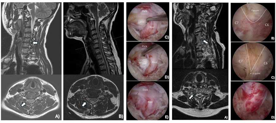 Unilateral Biportal Endoscopic Cervical Discectomy. Preoperative (A) and Postoperative Magnetic Resonance Images (B). Operative View Before the Discectomy, (C) During the Discectomy (D), and After the Discectomy (E). All Images Were Provided by Dr Ji Soo Ha.