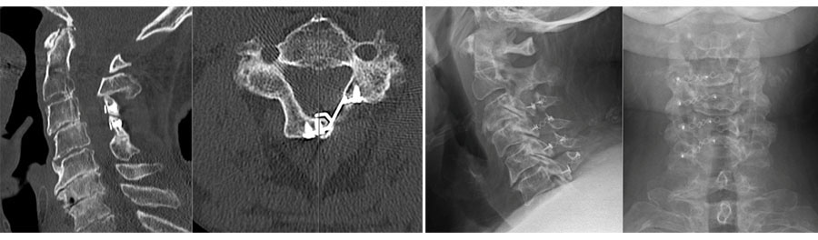 Post-operative CT scan and cervical radiographs after posterior cervical laminoplasty, an important and effective treatment for DCM.
