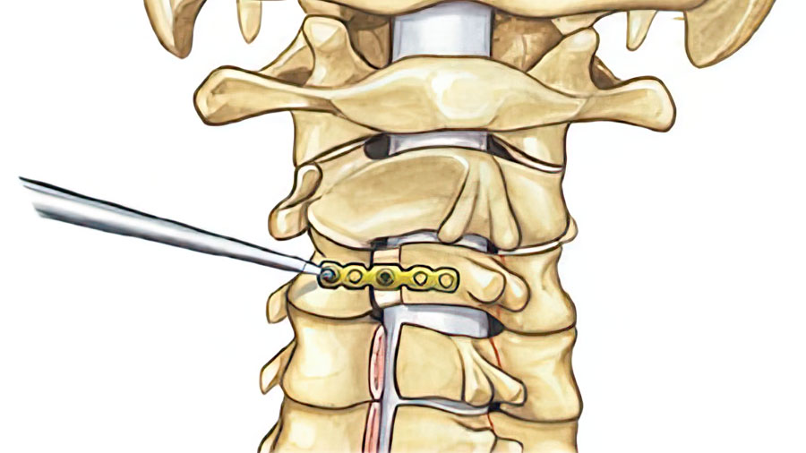 New GSJ Focus Issue is out: Motion Preserving Surgery for Degenerative Cervical Myelopathy