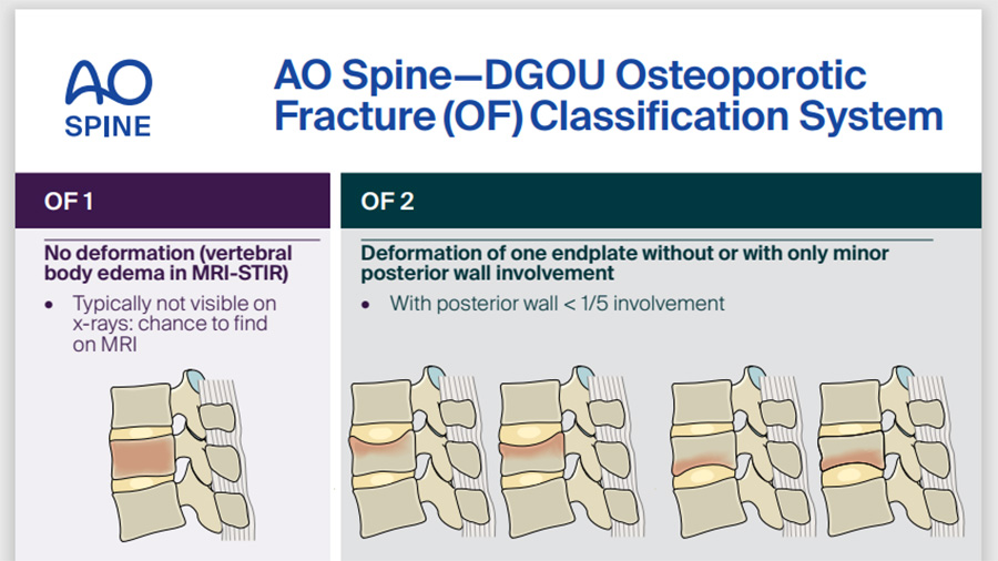 Osteoporotic Classification