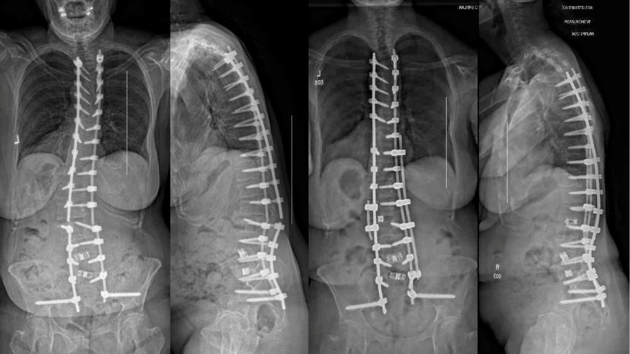 X-rays of using supplementary rod constructs in long-segment posterior instrumented spinal fusion procedures.