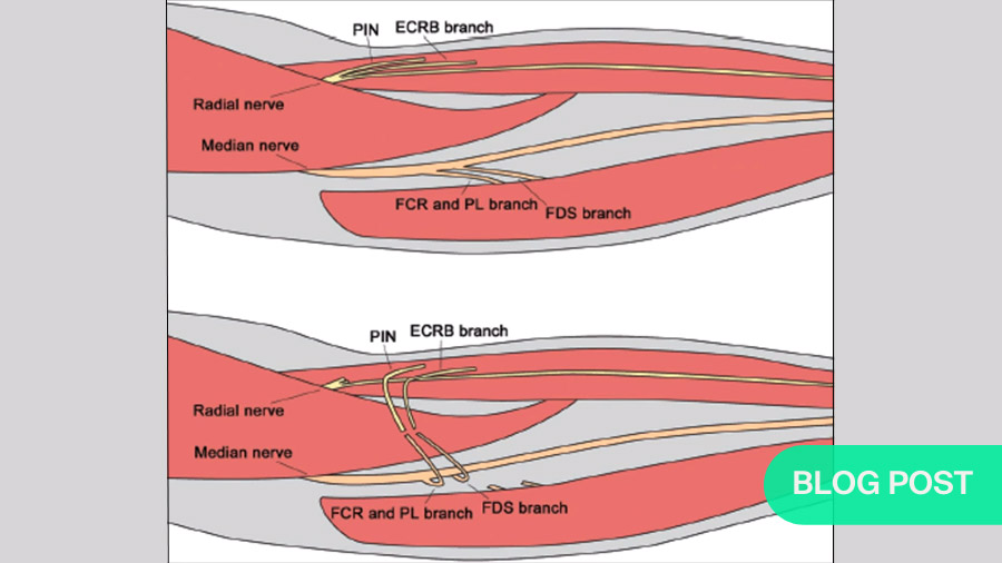 Blog Nerve Palsy