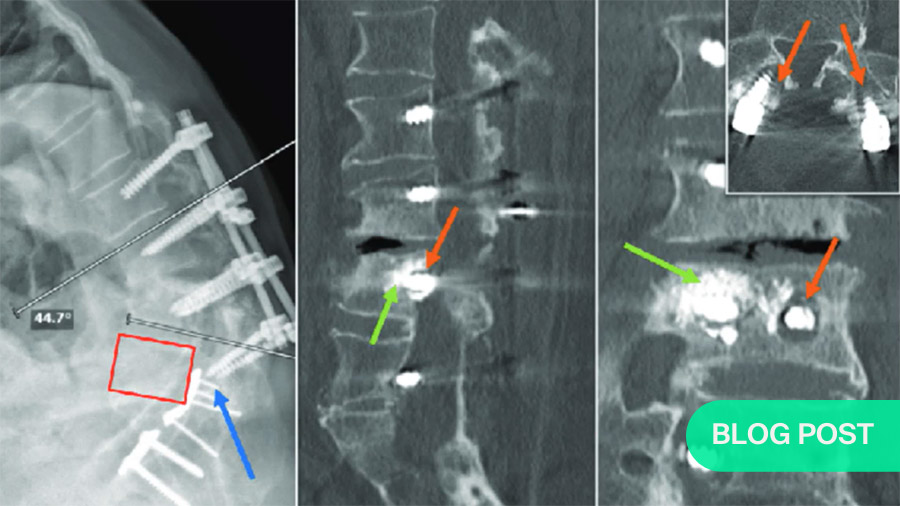 osteoporosis fracture sites