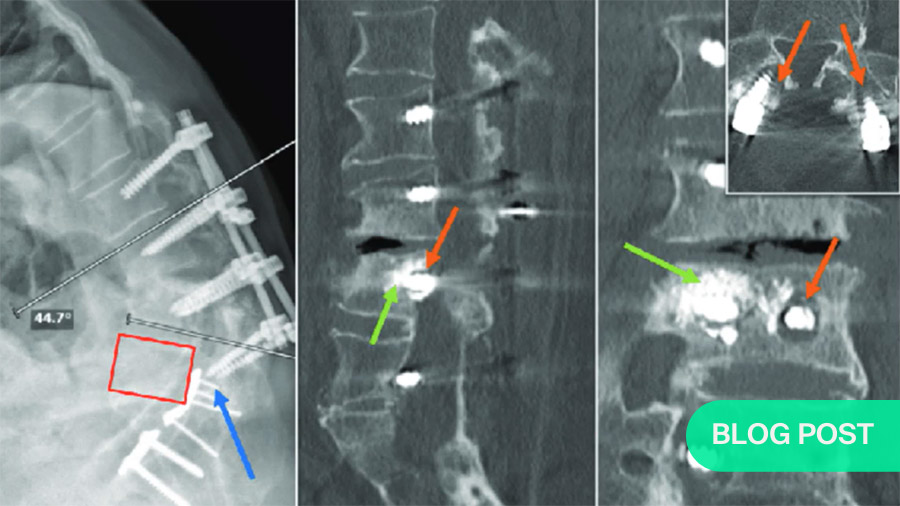 Osteoporosis: The Silent Killer 