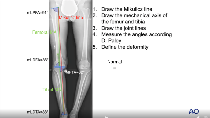 896px x 503px - Open Wedge High Tibial Osteotomy Principles and Techniques