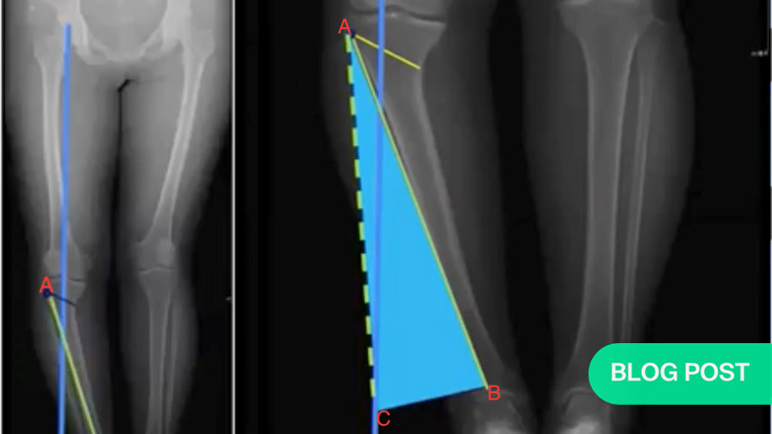 Open Wedge High Tibial Osteotomy Principles and Techniques