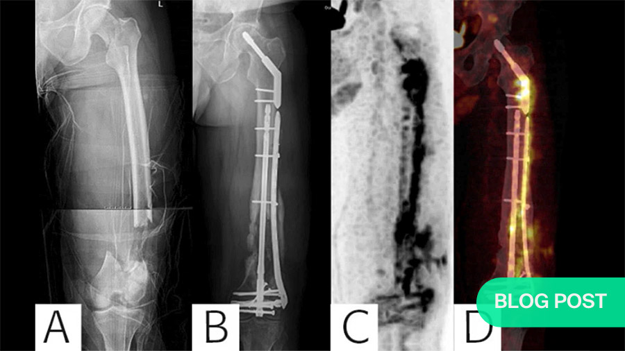 Fracture-related infection: Consensus recommendations on diagnosis and treatment (an AO webinar)
