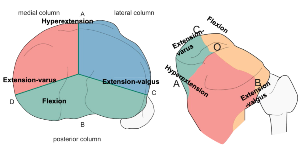 Tibia plateau fractures