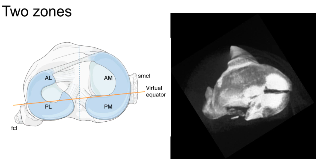 Tibia plateau fractures