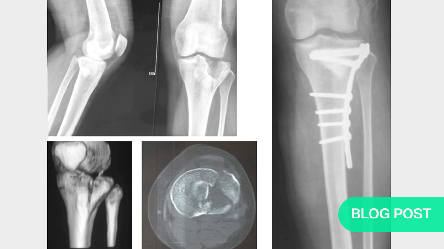3D four-column classification and 3D images of complex tibial plateau fractures with posterior articular involvement: New tools for planning treatment 