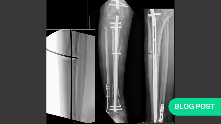 Bone Loss in Tibial Fractures 