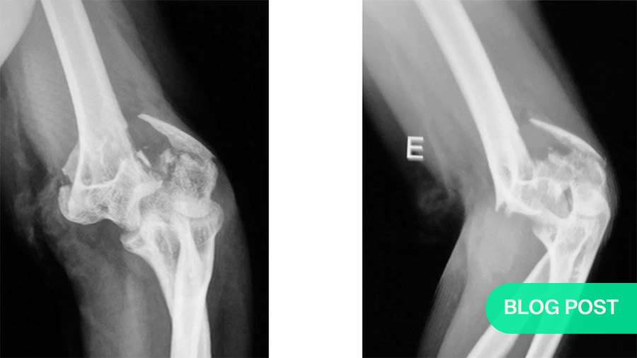 13C3 distal humeral fractures and possible olecranon osteotomy
