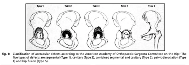State of the art fixation in periprosthetic fractures, revision of ...