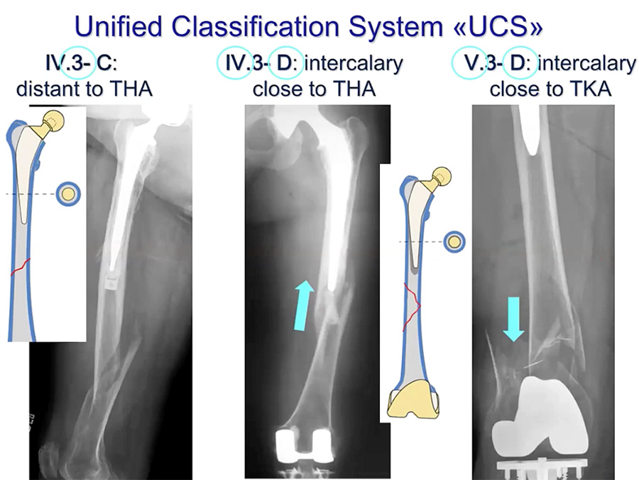 State of the art fixation in periprosthetic fractures, revision of ...