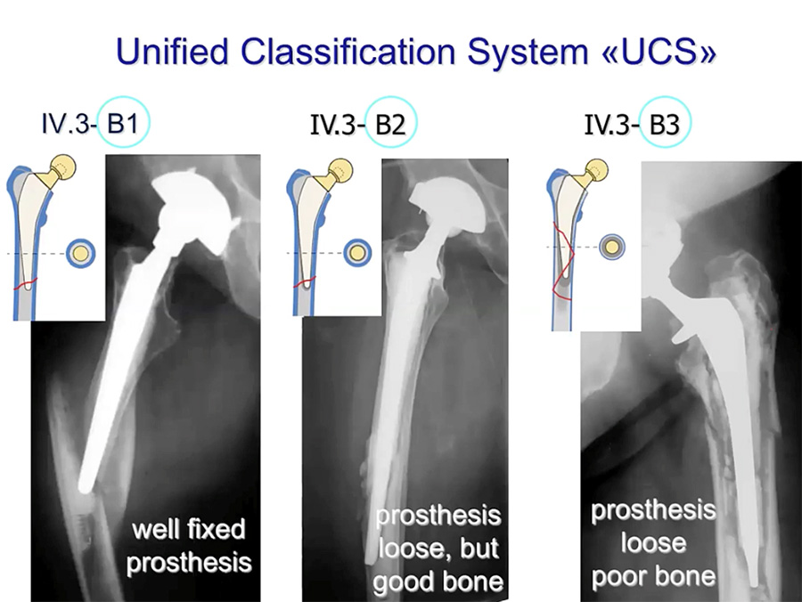 State of the art fixation in periprosthetic fractures, revision of ...