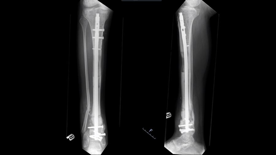 Blog Open bone fractures