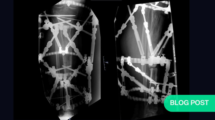 Open bone fractures—limb salvage or amputation? Putting ourselves in the position of the patient