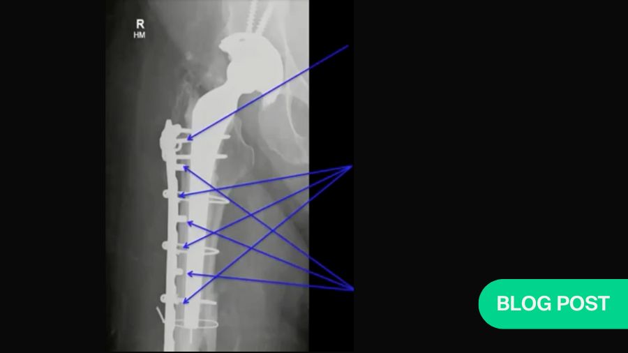 Periprosthetic fractures, management of the hip and the knee