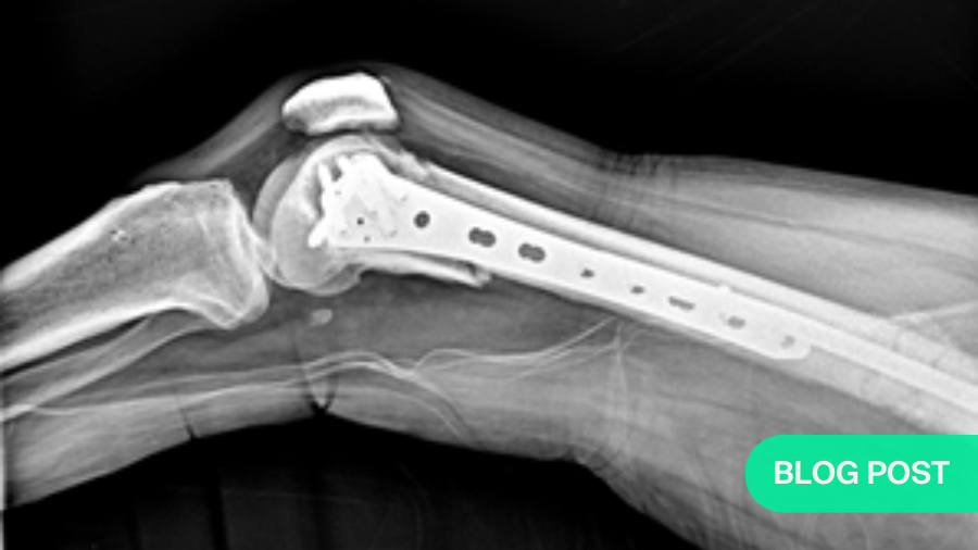 Trifocal femur fracture, one month post op