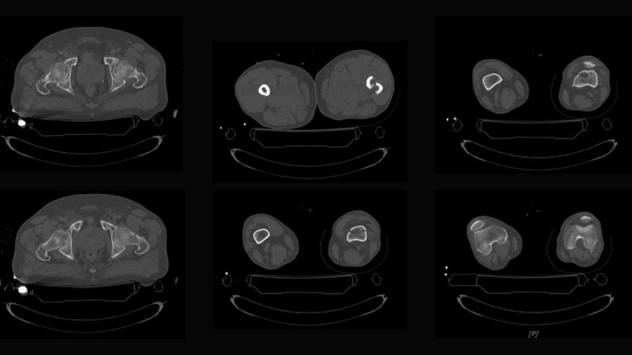 Trifocal femur fracture_2