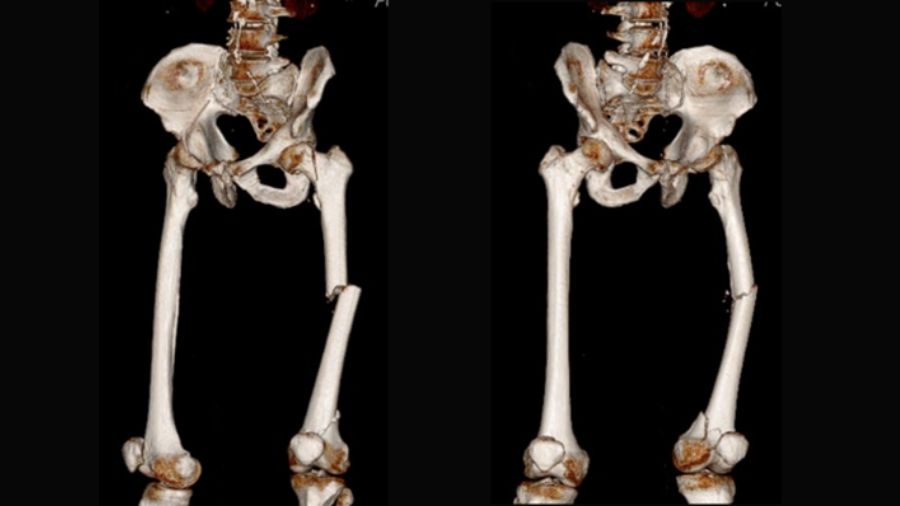 Trifocal femur fracture
