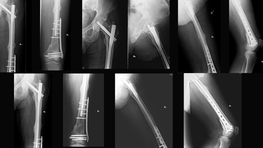 Trifocal femur fracture four and six months postoperative