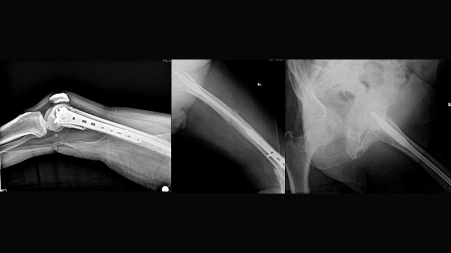 Trifocal femur fracture one month post op