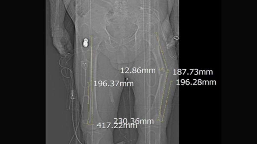 Trifocal femur fracture preoperative planning