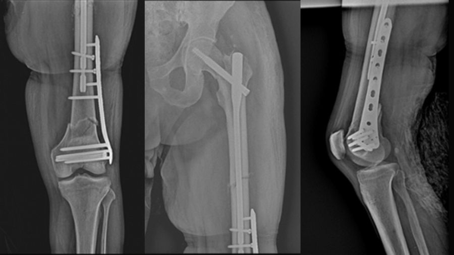 Trifocal femur fracture postoperative images