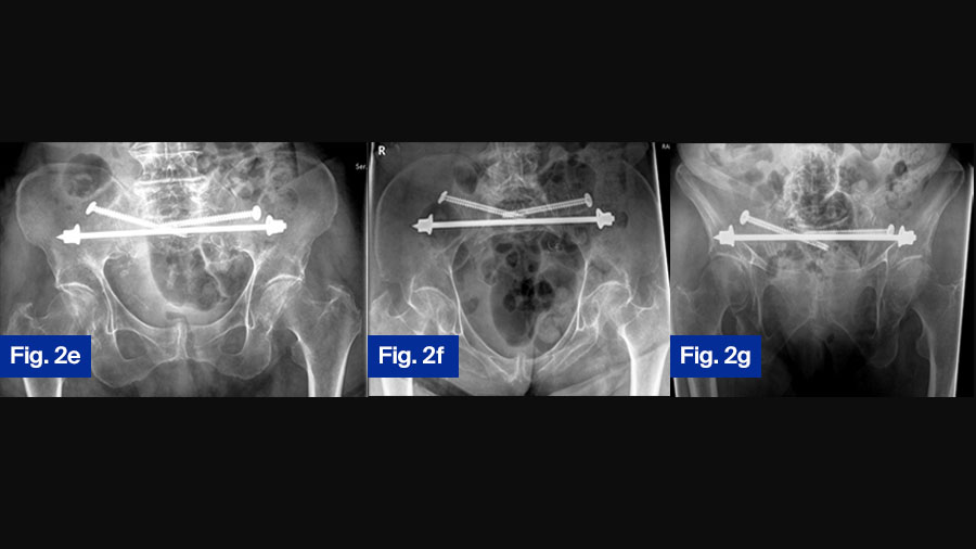 FFP case study 2: 92-year-old female (e, f, and g)