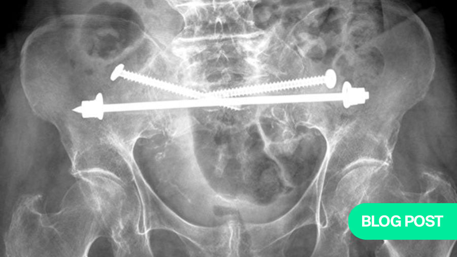 Fragility fractures of the pelvis (FFP): an emerging clinical entity