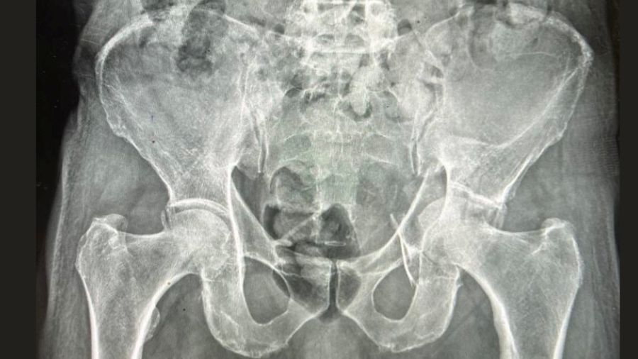 X-rays of a male patient 81 years old presented with left Acetabular fracture treated with ORIF using locked plates and screws. 