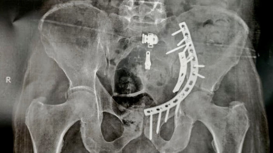 X-rays of a male patient 81 years old presented with left Acetabular fracture treated with ORIF using locked plates and screws.