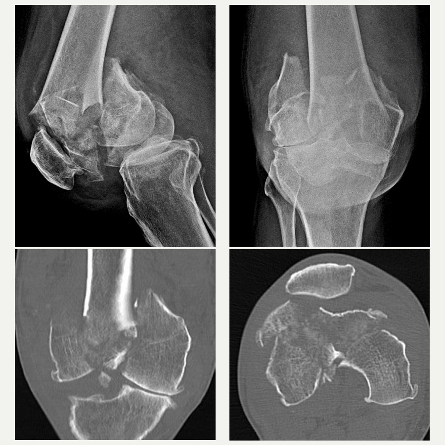 Highly comminuted knee fracture management
