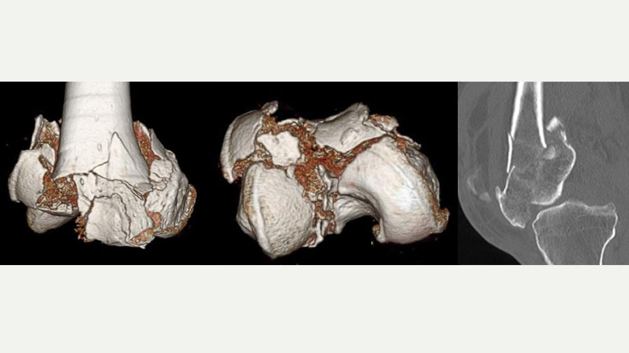 Highly comminuted knee fracture management