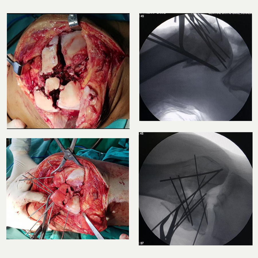 Highly comminuted knee fracture management